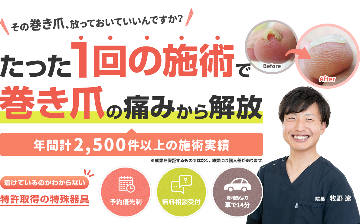 たった1回の施術で巻き爪の痛みから解放
