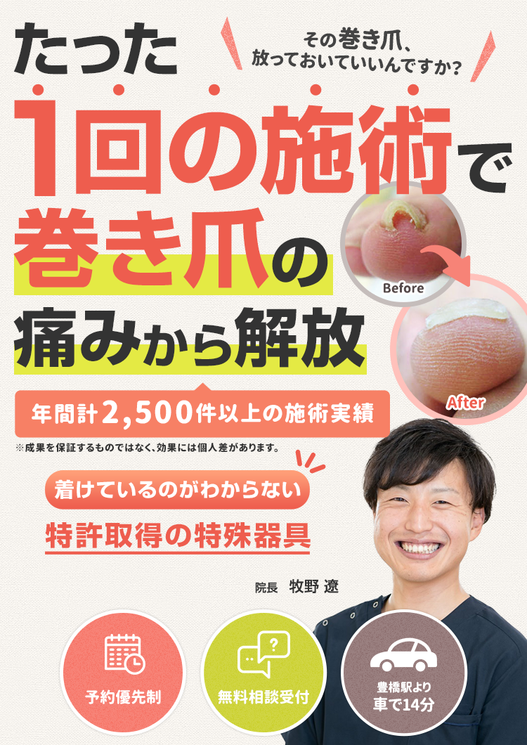 たった1回の施術で巻き爪の痛みから解放